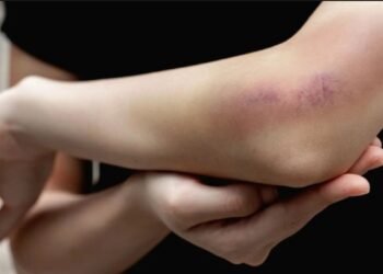 Luka Memar Usai Terbentur? Ini 6 Langkah Cepat Mengatasinya